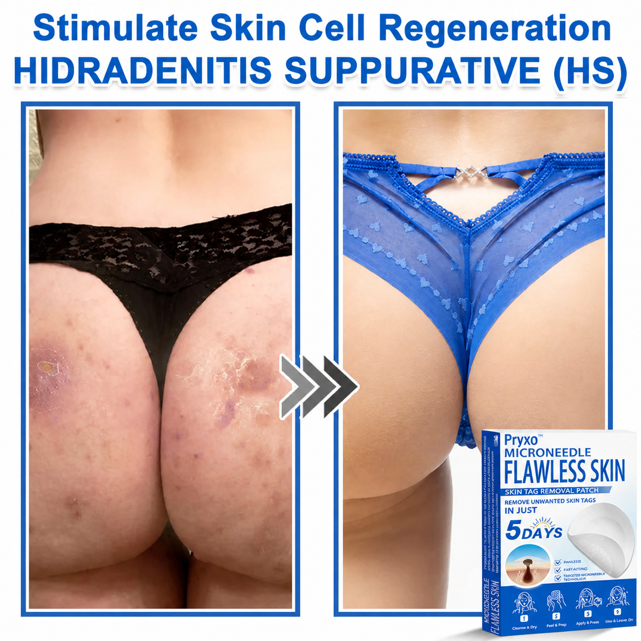 Pryxo™ 2-in-1 Microneedle & Hydrocolloid Patch | Raised Moles,Acne,  Flat Warts & Skin Tags Remover | Improves Wrinkles, Scars & Blemishes | Invisible Pimple Patches for Face & Body