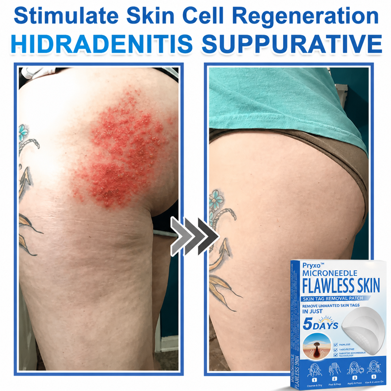 Pryxo™ 2-in-1 Microneedle & Hydrocolloid Patch | Raised Moles,Acne,  Flat Warts & Skin Tags Remover | Improves Wrinkles, Scars & Blemishes | Invisible Pimple Patches for Face & Body