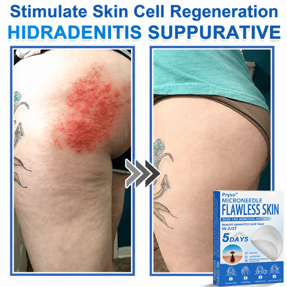Pryxo™ 2-in-1 Microneedle & Hydrocolloid Patch | Raised Moles,Acne,  Flat Warts & Skin Tags Remover | Improves Wrinkles, Scars & Blemishes | Invisible Pimple Patches for Face & Body