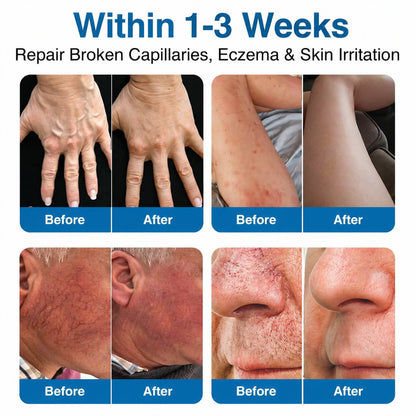 Virexo™ VeinRepair Microneedle Patch Roll⚡Instant Relief, Long-Term Results