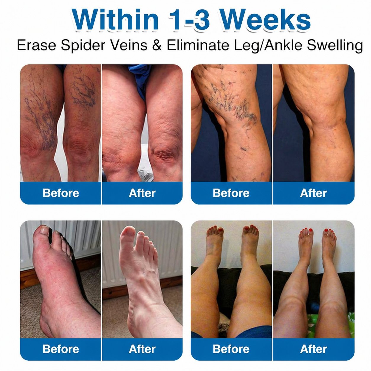 Virexo™ VeinRepair Microneedle Patch Roll⚡Instant Relief, Long-Term Results