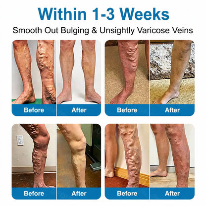 Virexo™ VeinRepair Microneedle Patch Roll⚡Instant Relief, Long-Term Results