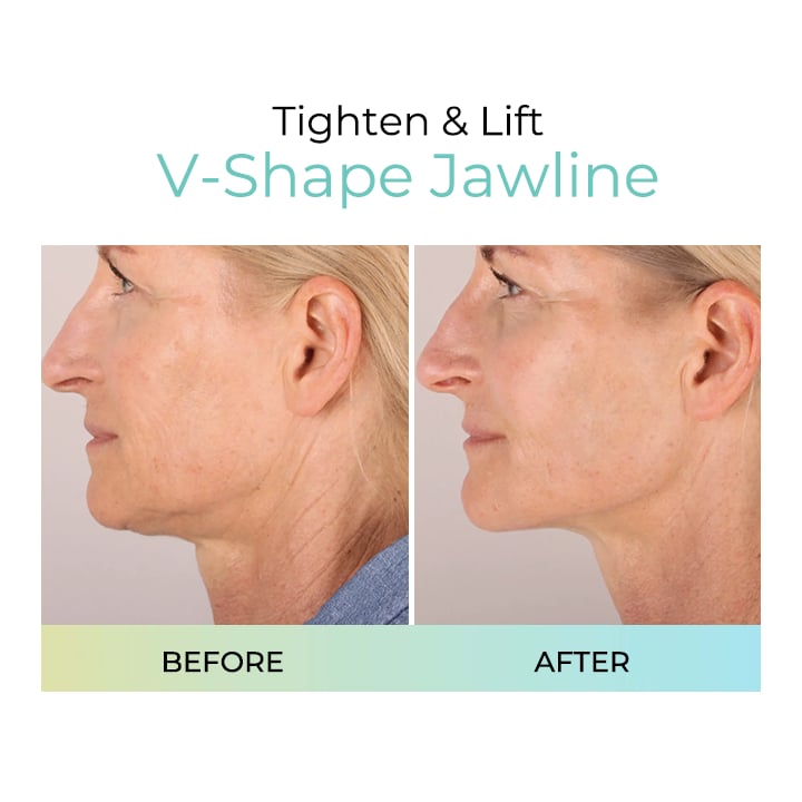 Reveal Firm, Smooth Skin – LUMIVO™ Anti-Wrinkle Pads for Your Youthful Transformation