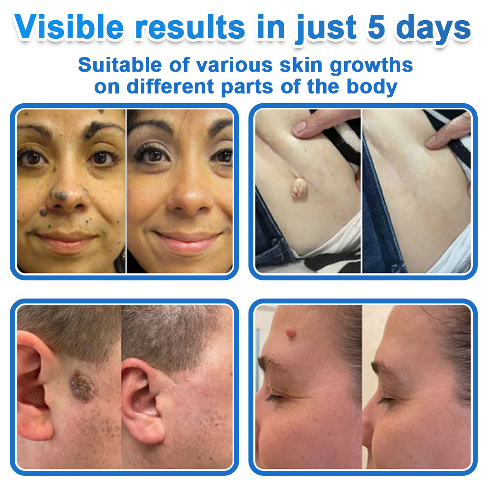 Pryxo™ 2-in-1 Microneedle & Hydrocolloid Patch | Raised Moles,Acne,  Flat Warts & Skin Tags Remover | Improves Wrinkles, Scars & Blemishes | Invisible Pimple Patches for Face & Body