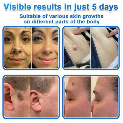 Pryxo™ 2-in-1 Microneedle & Hydrocolloid Patch | Raised Moles,Acne,  Flat Warts & Skin Tags Remover | Improves Wrinkles, Scars & Blemishes | Invisible Pimple Patches for Face & Body