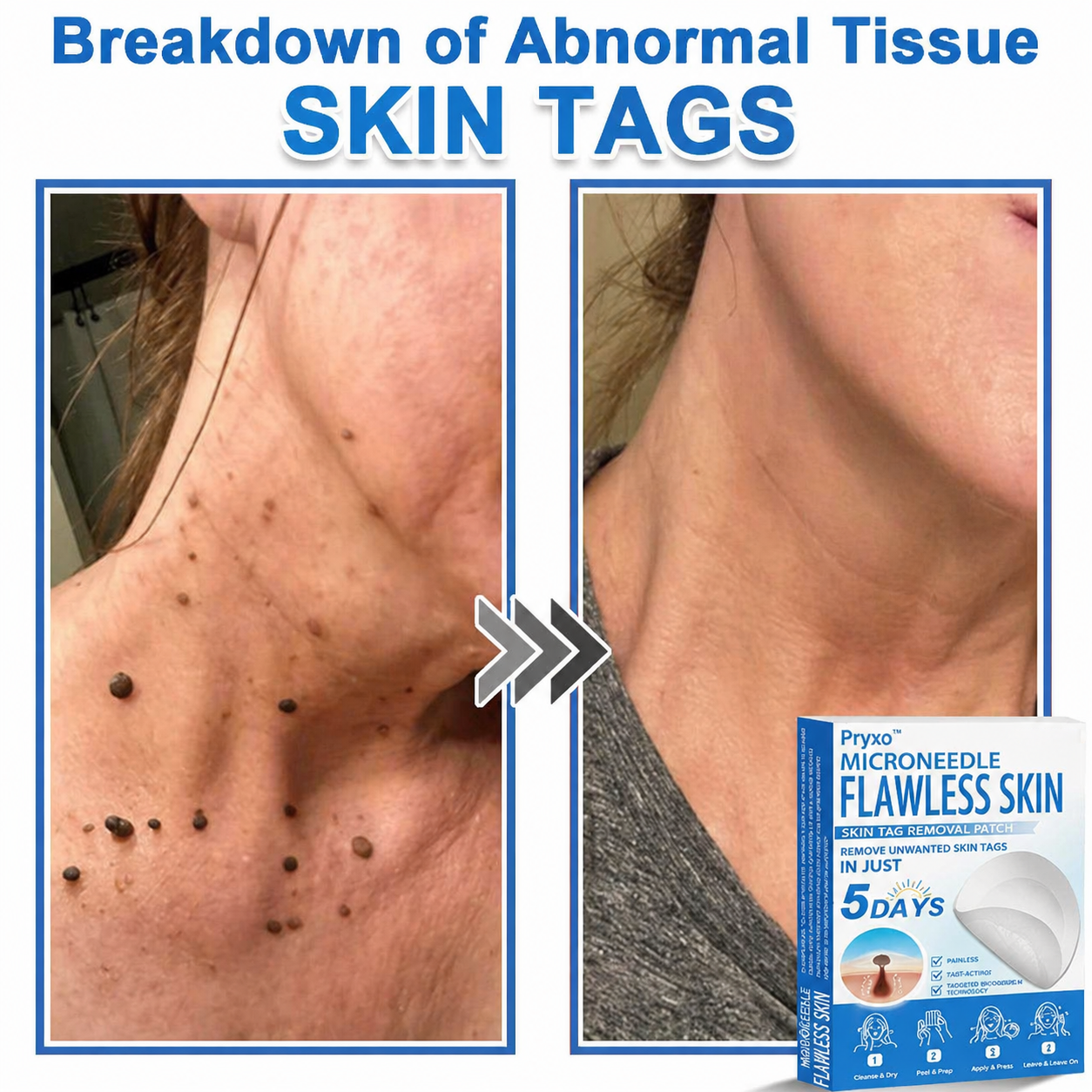 Pryxo™ 2-in-1 Microneedle & Hydrocolloid Patch | Raised Moles,Acne,  Flat Warts & Skin Tags Remover | Improves Wrinkles, Scars & Blemishes | Invisible Pimple Patches for Face & Body