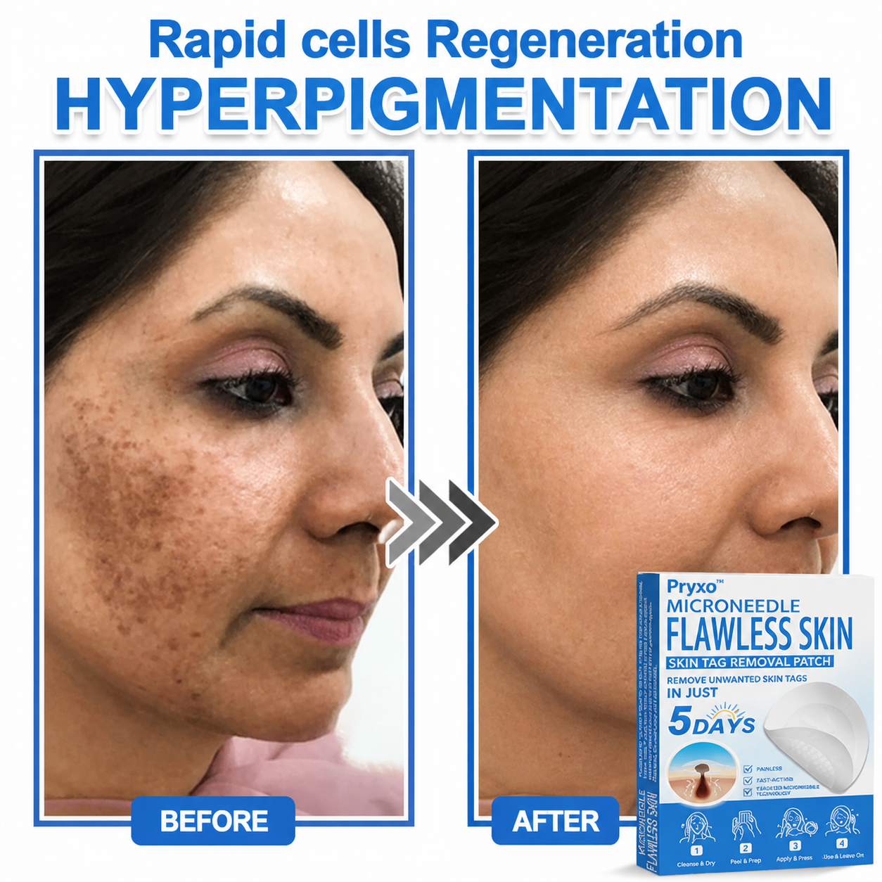 Pryxo™ 2-in-1 Microneedle & Hydrocolloid Patch | Raised Moles,Acne,  Flat Warts & Skin Tags Remover | Improves Wrinkles, Scars & Blemishes | Invisible Pimple Patches for Face & Body