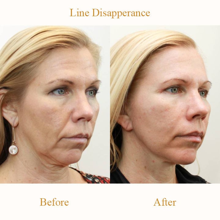 Reveal Firm, Smooth Skin – LUMIVO™ Anti-Wrinkle Pads for Your Youthful Transformation